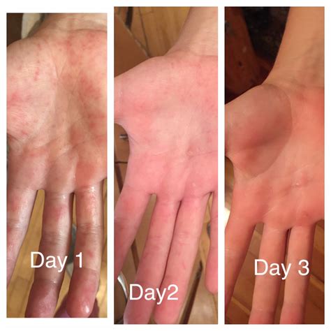 Hand Foot And Mouth Timeline