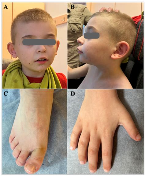 Novel RAI1:c.2736delC Variant in Smith–Magenis Syndrome: Identification ...