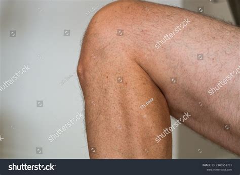 28 Growth Plate Fractures Injuries Images, Stock Photos & Vectors | Shutterstock