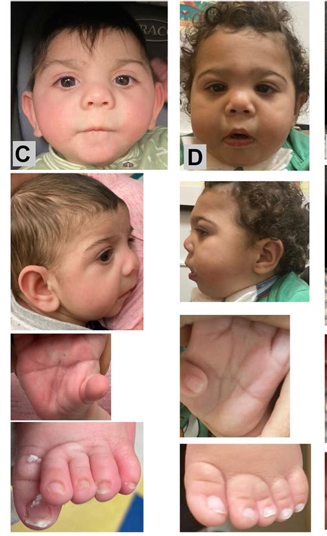 Birth Defects From Drug Abuse