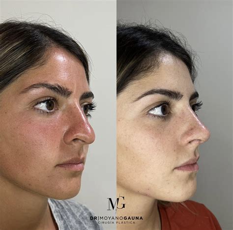 Rinoplastia antes y después | Doctor. Moyano Gauna