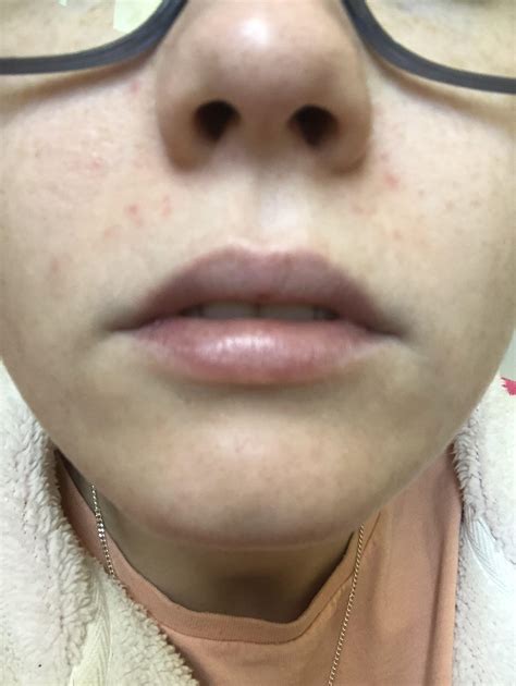 Is this fungal acne around my mouth? Little red bumps that aren't itchy ...