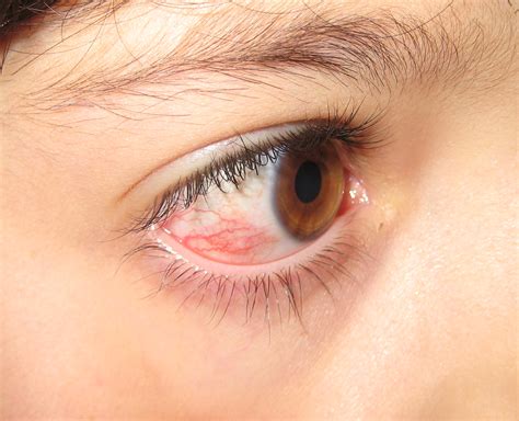 Episcleritis Vs Scleritis