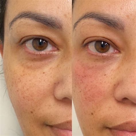 Bags Under Eyes And Tired at Cristal Lawrence blog