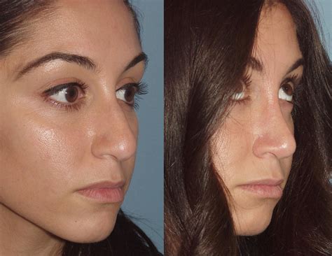Patient before and after rhinoplasty Rhinoplasty surgeon