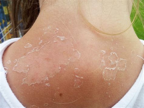 Worst Sunburn Peeling Will One Bad Sunburn Give You Skin Cancer?