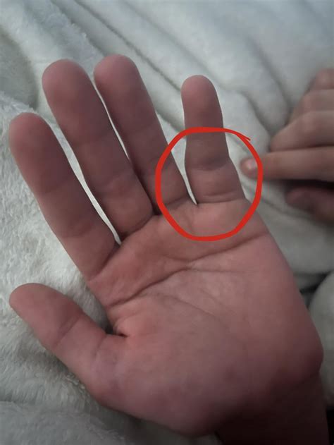 Is my finger broken? : r/surgeonbrokeabone