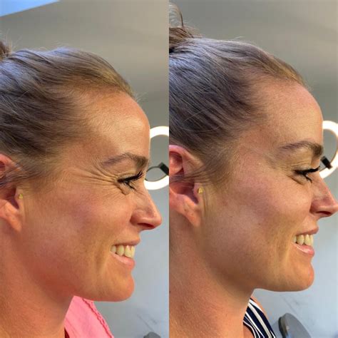 Botox Before And After Crows Feet