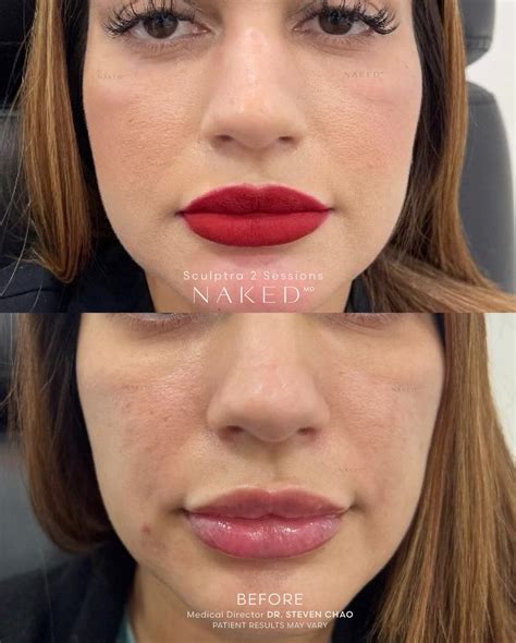 Sculptra® Filler & Injections in California and Arizona – NAKEDMD Medspa