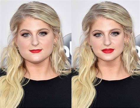 Meghan Trainor Face Surgery