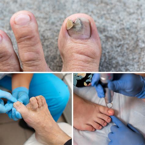 Types Of Toenail Fungus Mold at Alex Mckean blog