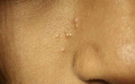 Small bumps that aren't pimples on face – Acne – Acne.org Forum