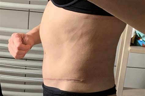 Why Does My Upper Abdomen Bulge Out? Common Causes and When to Worry