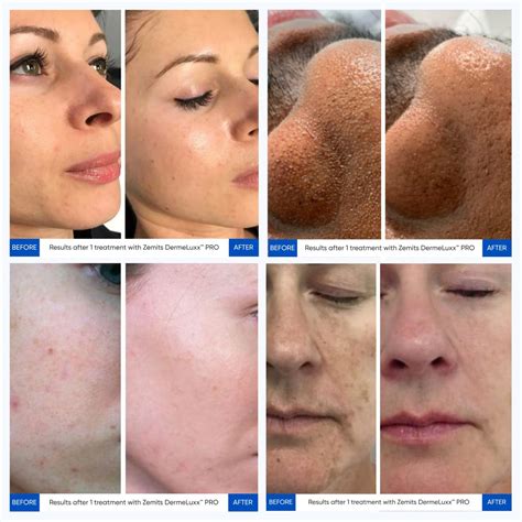 Zemits DermeLuxx | Hydrodermabrasion Machine For Sale