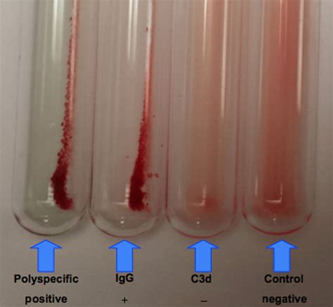 How to use: the direct antiglobulin test in newborns | ADC Education ...
