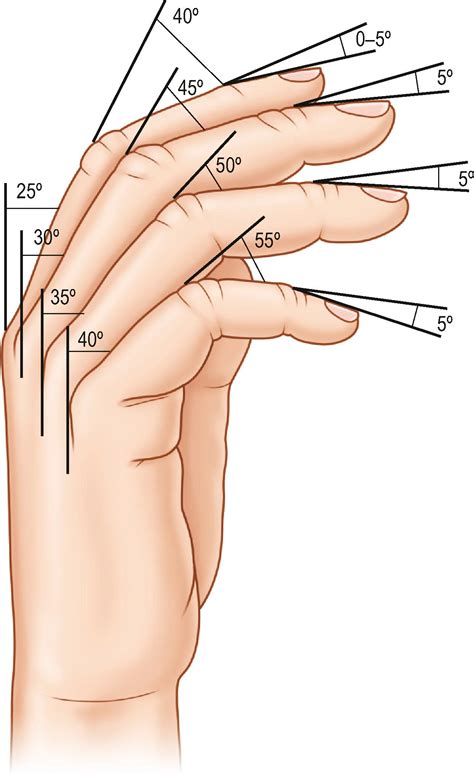 Osteoarthritis in the hand and wrist - Clinical Tree