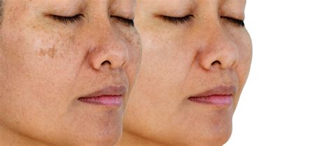 Melasma and Aging: Navigating Changes in Skin Pigmentation Over Time - Health Afternoon