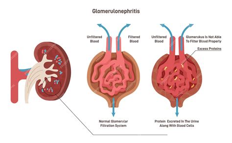 Glomerulonephritis Types