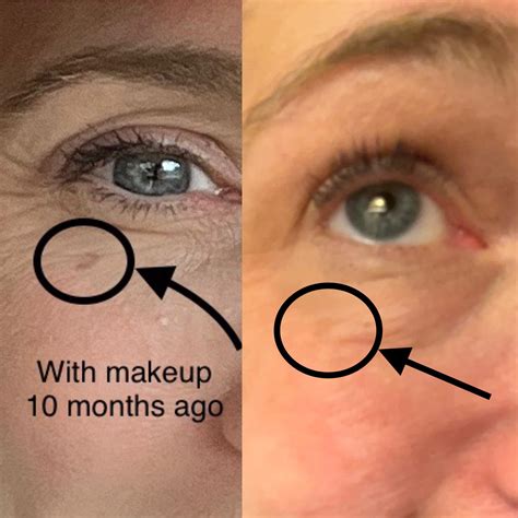 [B&A] 2 months of skincare hyperpigmentation : r/SkincareAddiction