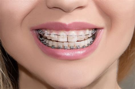 How Do You Treat White Spots After Braces? - Healthrow.net