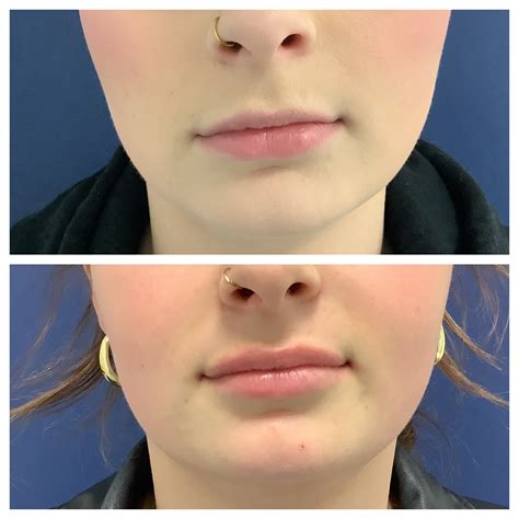 Lip flip behandeling met Botox - Kliniek Vrijdag