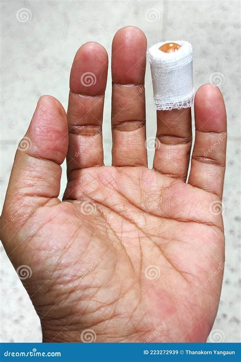 The Knife Cut Off Left Ring Finger, Laceration Wound , Accident at Home. Stock Image - Image of ...