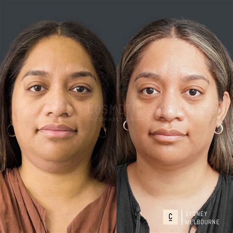 Double Chin Removal Results: Fat Dissolving Before & After Photos