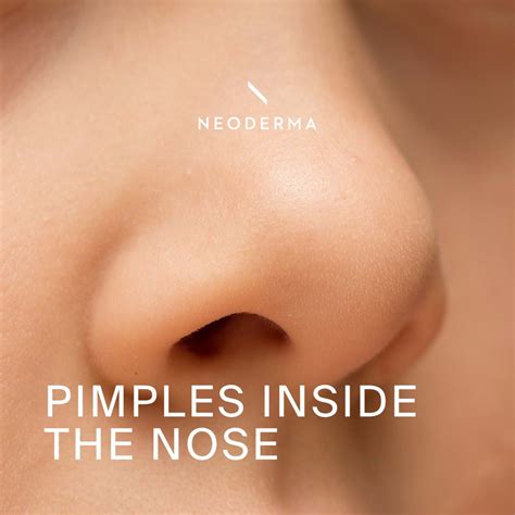 Pimples Inside the Nose - NEODERMA