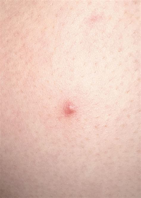 Is silicone tape can prevent early keloid from growing? : r/Keloids