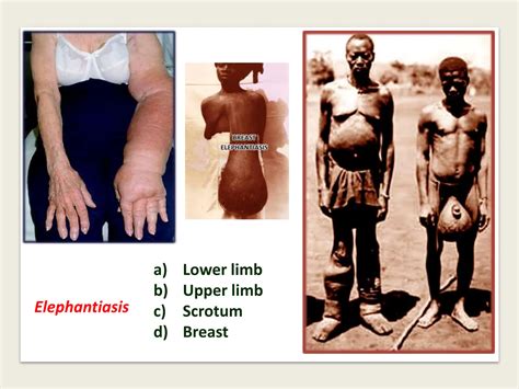 Filariae species & Lymphatic filariasis.pptx
