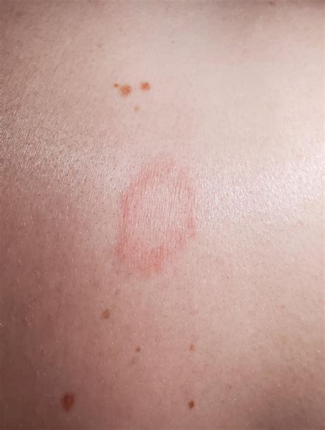 I'm at my wit's end with this rash that keeps spreading. Erythema ...