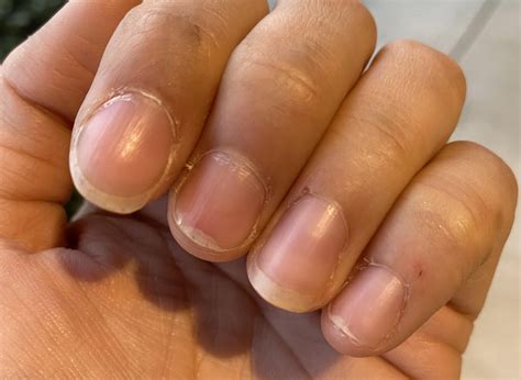 Why Are My Fingernails Separating From Nail Bed at Mia Fox blog