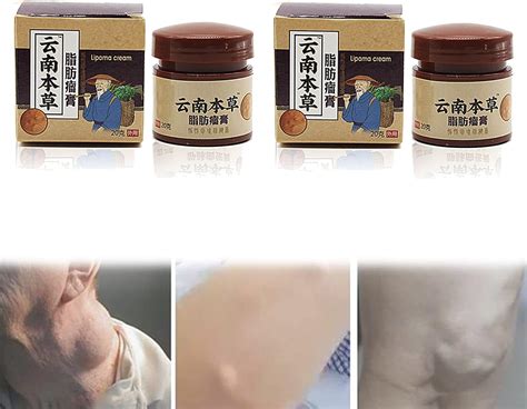 Buy Amdieu Magical Lipoma Elimination Cream Lipoma Lumps Removal Cream Lumpfree Lipoma Removal ...