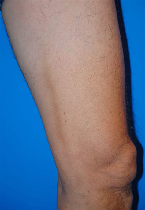 Is It Normal to Have Lumps and Tightness in the Thigh After Varicose ...