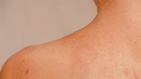 Pityriasis Rocea: Symptoms, Causes, & Treatment - Toronto Dermatology Centre