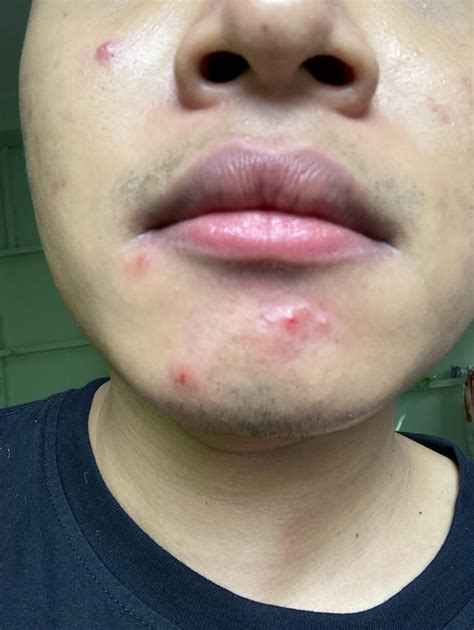 Gram negative folliculitis? : r/Folliculitis