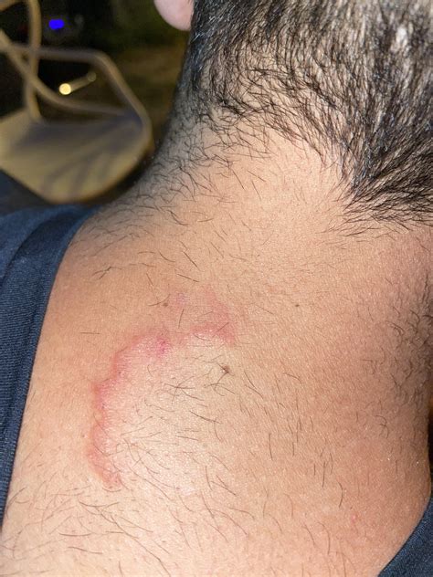 Rash On Back Of Neck After Shower at Troy Jenkins blog
