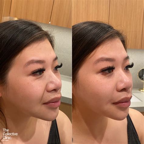 Smile Line Filler — The Collective Clinic