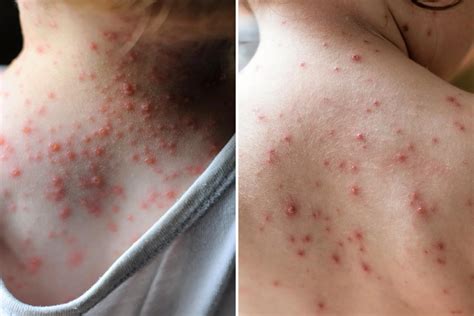Chickenpox (Varicella): Symptoms, Treatment, and Prevention