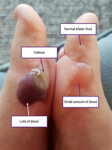 How To Treat A Burn Blister On Foot at Katina Woods blog