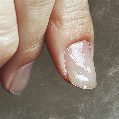 Koilonychia 5 Diseases That Nails Can Reveal