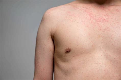 Measles vs Chickenpox: How Can You Tell the Difference? - Touchwood ...