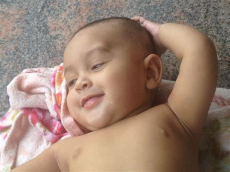 Dermoid Cyst Forehead