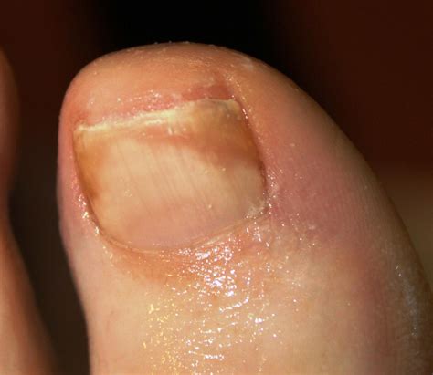 Nail Psoriasis Telltale Signs Of Nail Psoriasis And When Nail Psoriasis: Nail Psoriasis Symptoms ...
