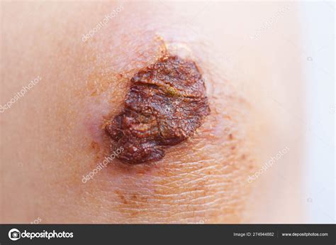 Scar Scab Eschar Female Knee — Stock Photo © lzf #274944882