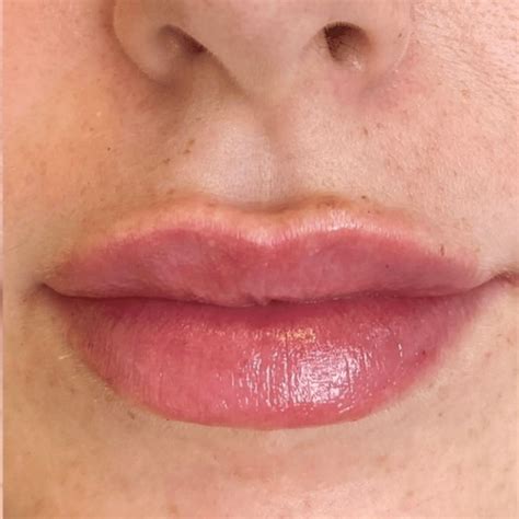 Dissolve and Refill Lip Fillers: What it is and why its dangerous ...