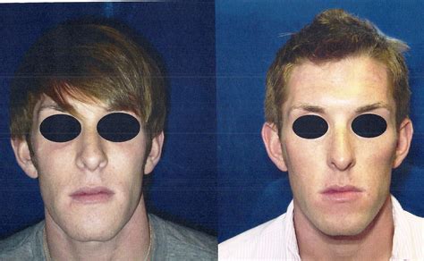 Before and After Pictures of Jaw Surgery | Oral Surgery Boca & Delray