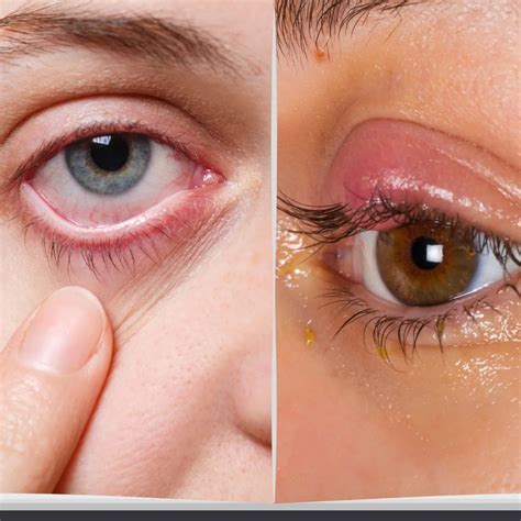 Blepharitis Vs. Chalazion: Eye Doctor's Insights on Symptoms and Treatments - eyeFACTS
