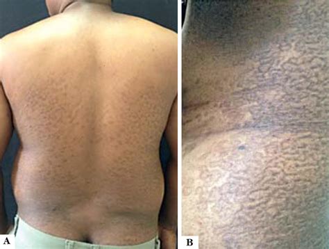 Papilomatose Confluente E Reticulada De Gougerot Carteaud - RETOEDU