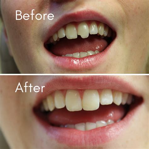 Fix a Chipped Tooth at Home: Easy Tips and Tricks